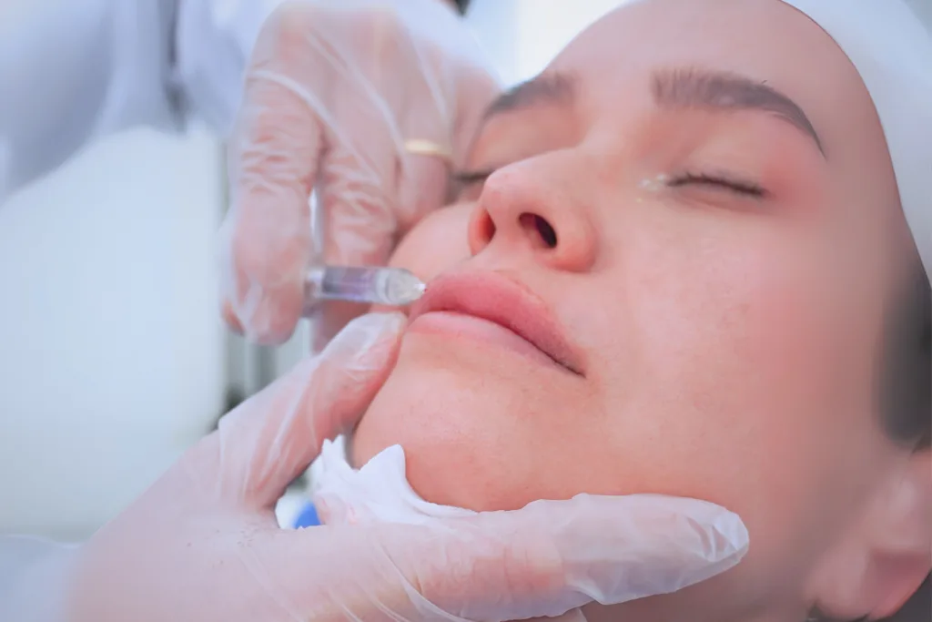 perfilamiento de labios con acido hialuronico cliniderma